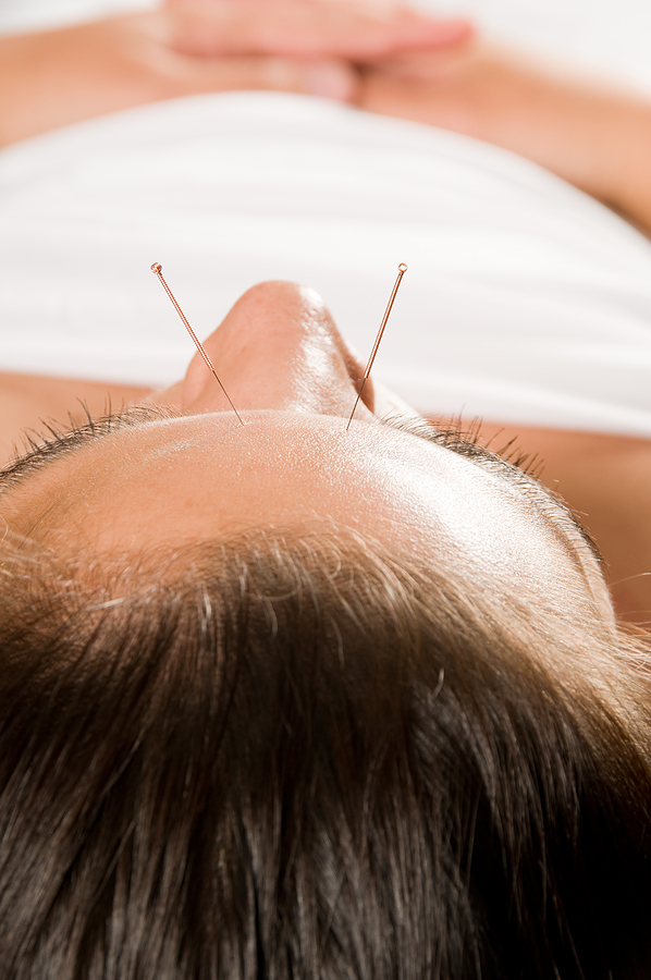 Acupuncture Therapy in Shoeburyness