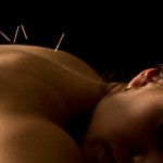acupuncture-needles-in-back